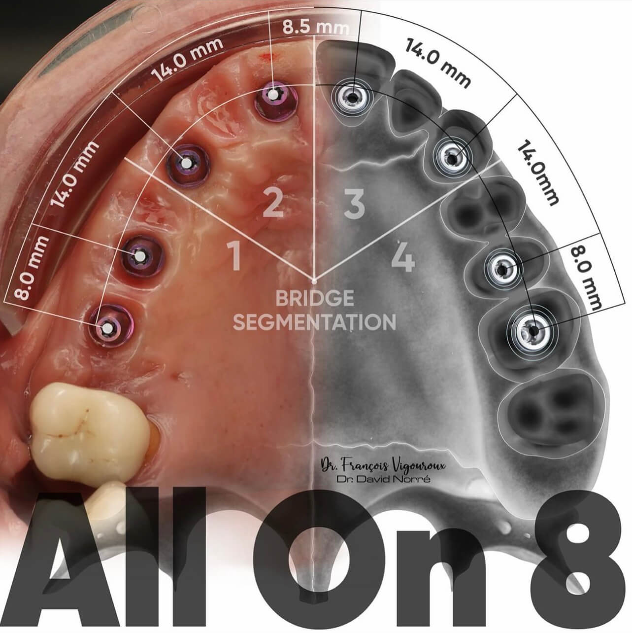 All-on-8: acht implantaten