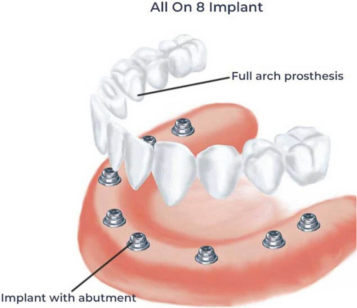all-on-8: acht implantaten