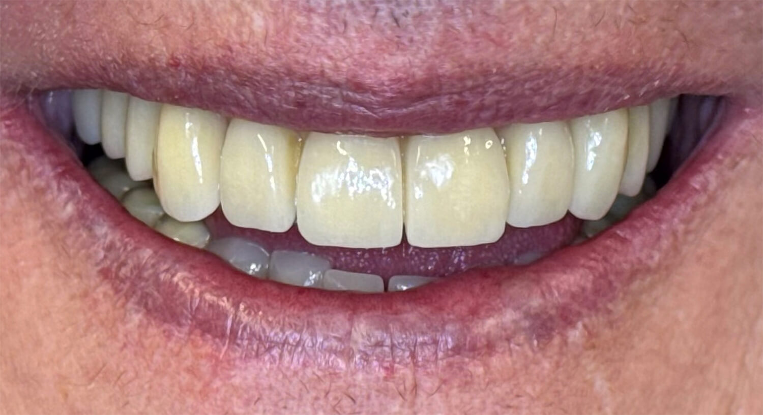 “3-on-6” behandeling bij Expertise Kliniek voor Implantologie Grave