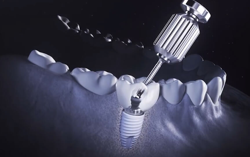 Implantaat met kroon