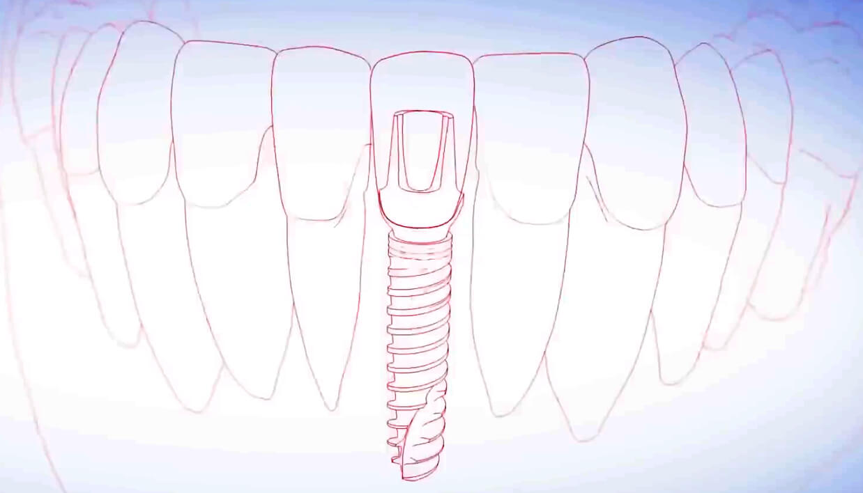 Implantaat onderfront met kroon