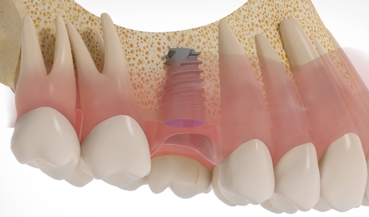Implantaat zonder kroon
