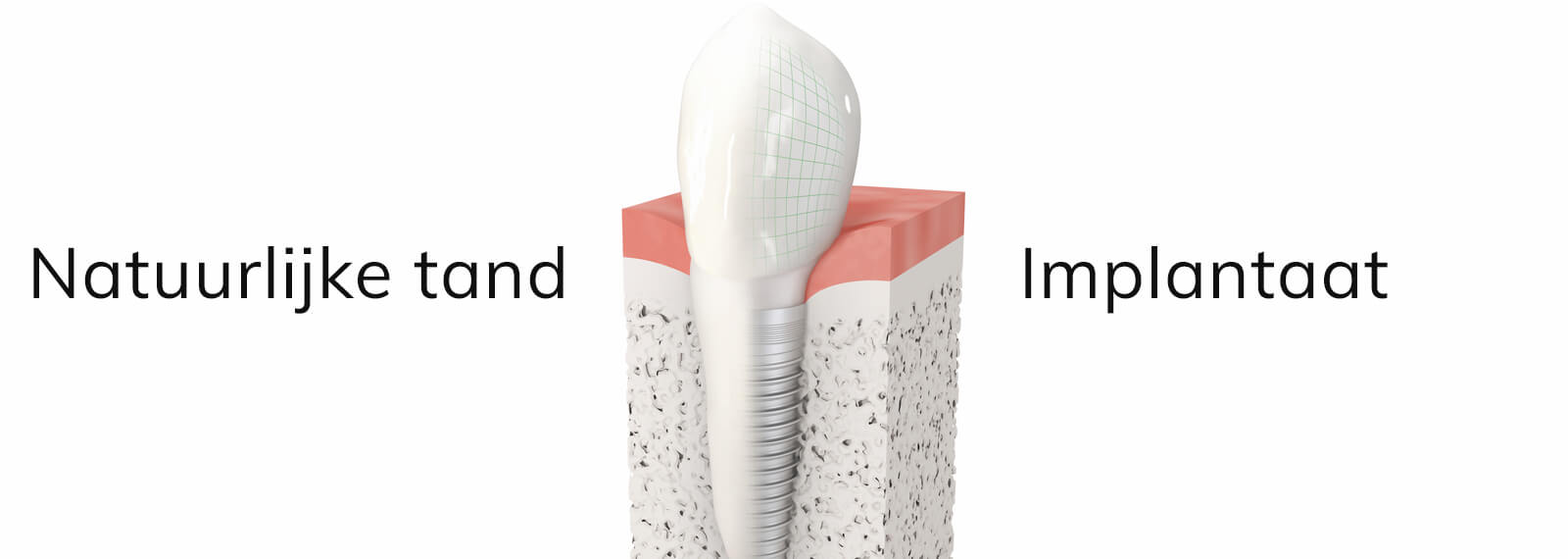 Hoe verschilt een implantaat van een echte tand?