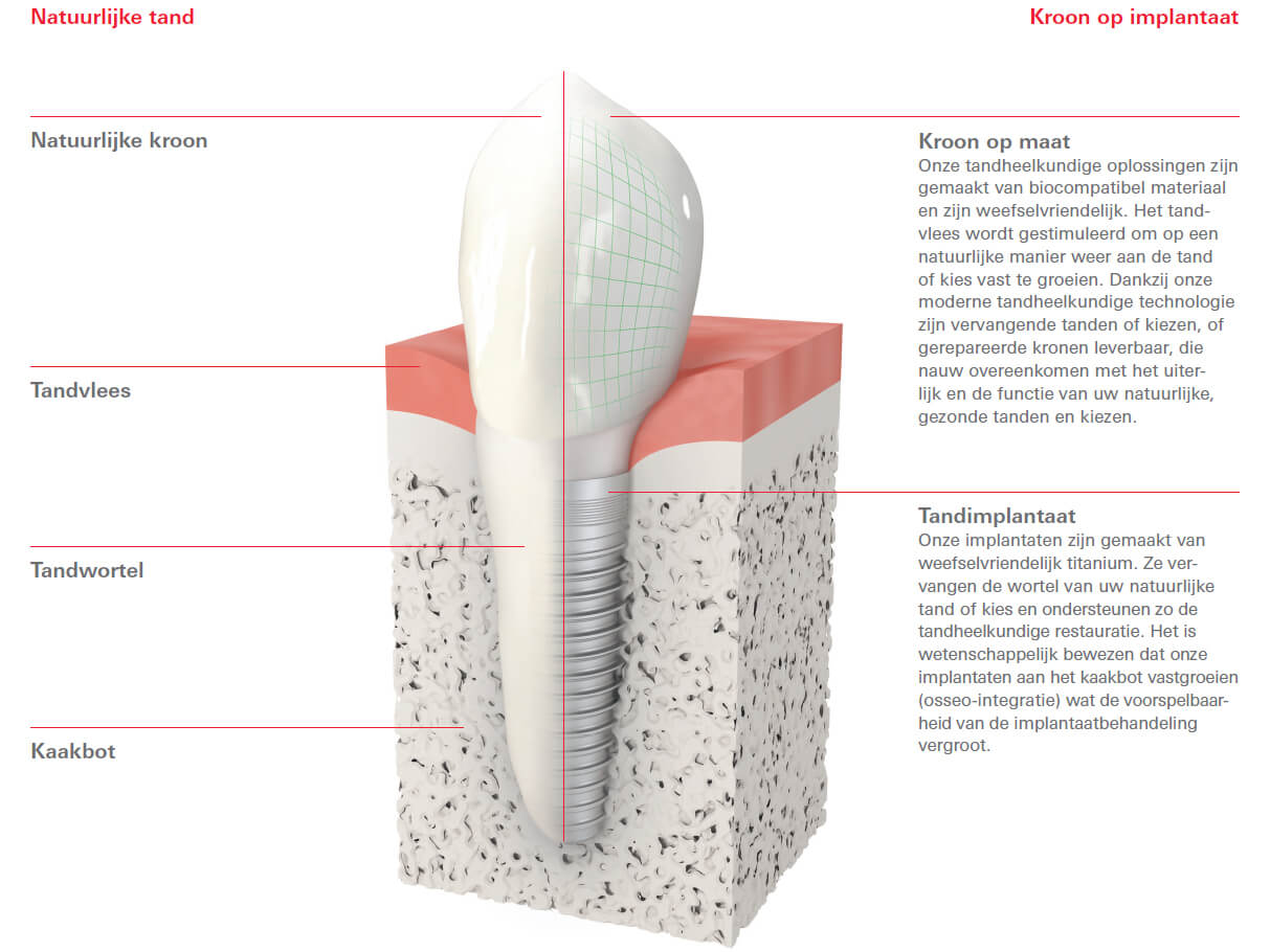 Verschil tussen implantaat en eigen tand of kies