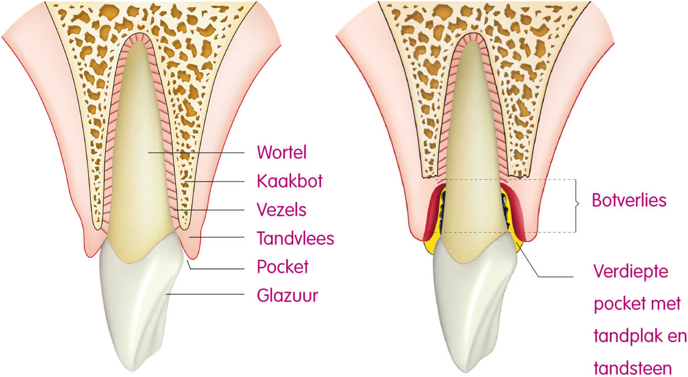 Wat is parodontitis?
