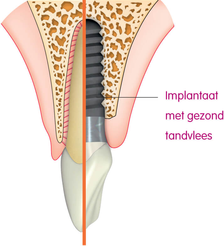 Implantologie na tandverlies door parodontitis