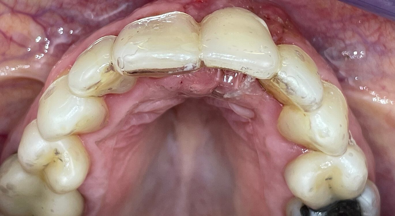 Essixspalk in de mond vanuit het aanzicht van het kauwvlak