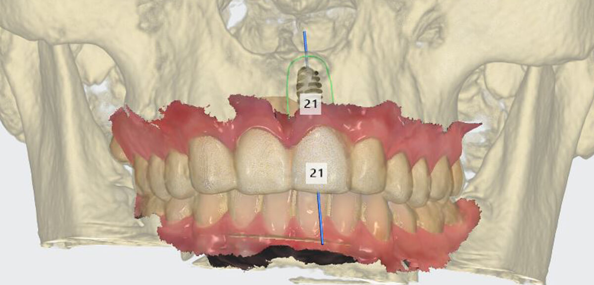 3D digitale intra-orale scan