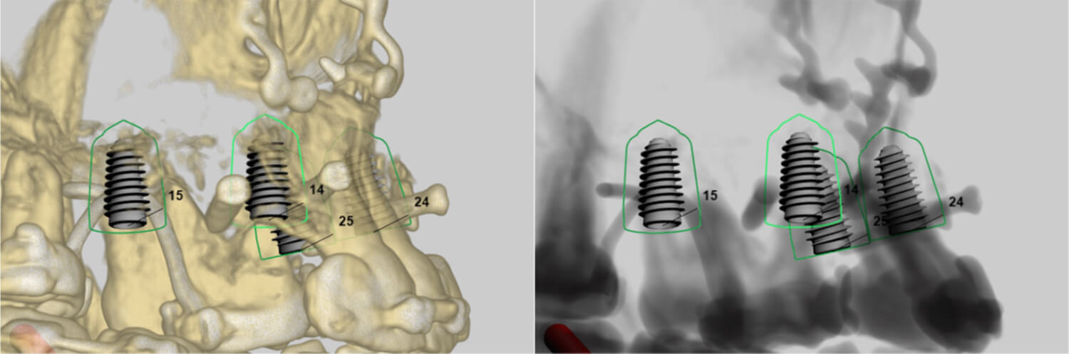 3D planning van 4 implantaten na een botopbouw