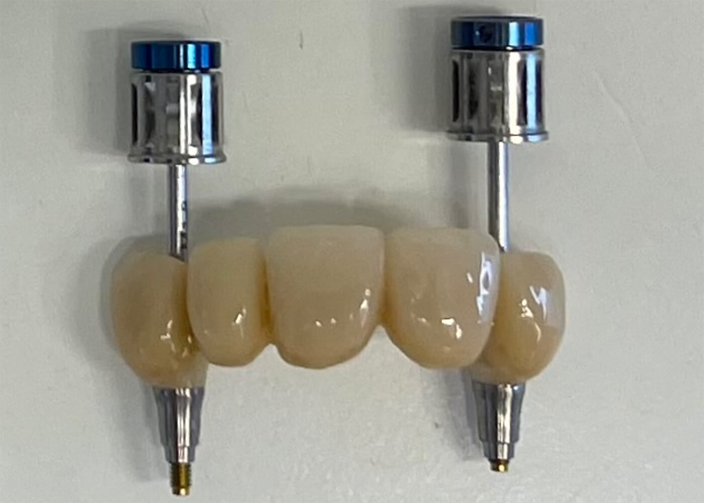 Implantaten zijn parallel geplaatst met boormal. Dit maakt het makkelijk om de definitieve brug te plaatsen.