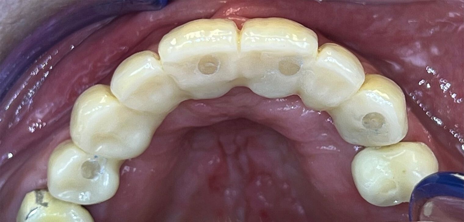 Uitdaging bij plaatsing van twee of meer implantaten