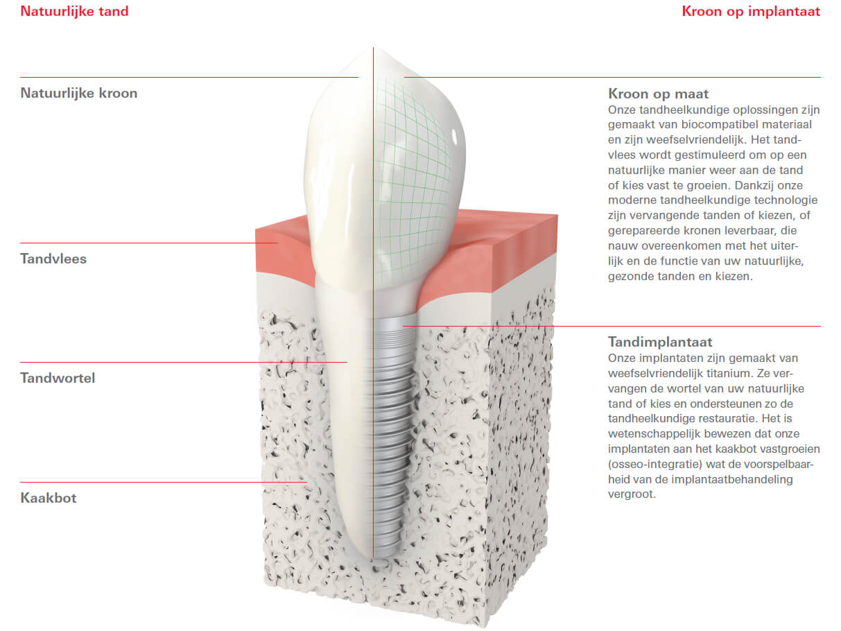 Natuurlijke tand versus implantaat